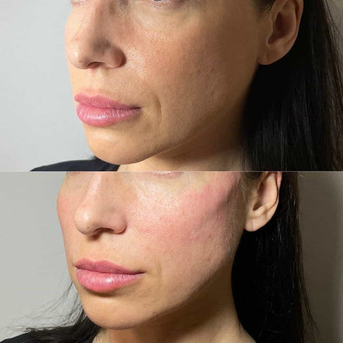 What Does Temple Filler Do Before And After