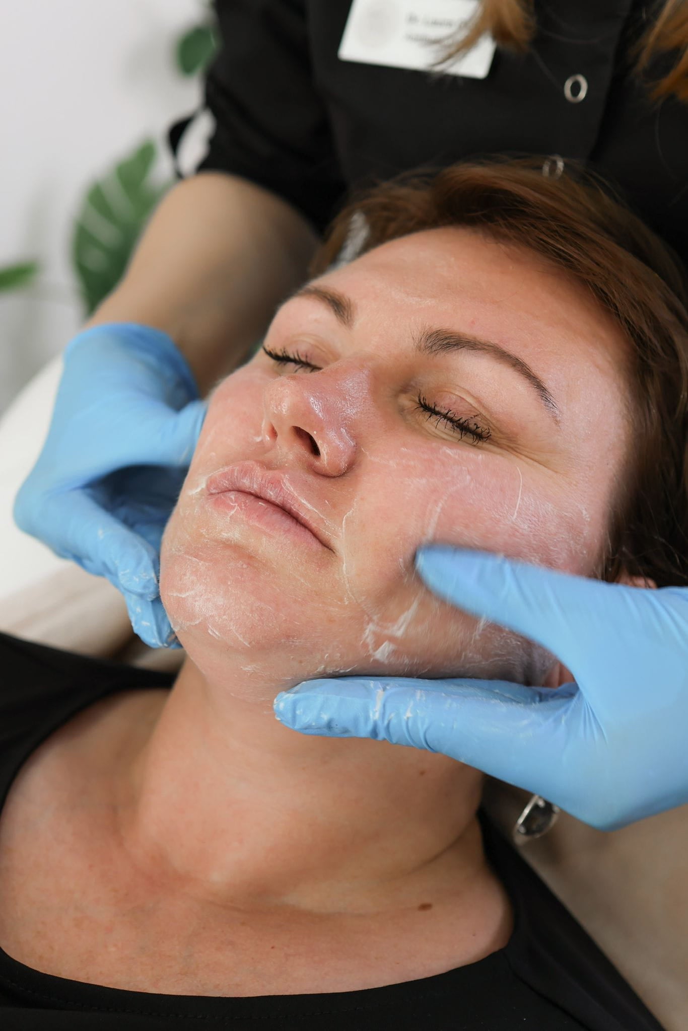 How Obagi Nu-Derm Skin System is used for skin resurfacing in Kingston Upon Thames Surrey London