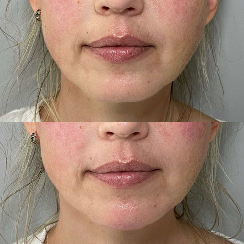 How Much Does Swelling Go Down After Lip Filler