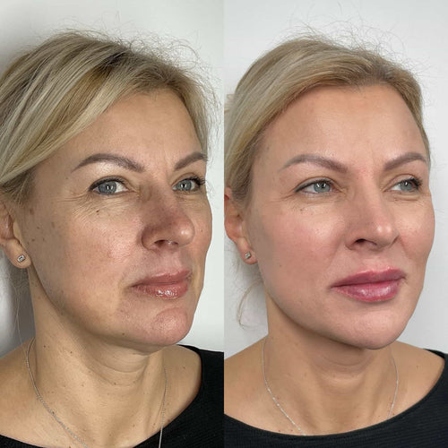 How long does ear lobe filler last?