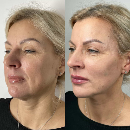 How long does ear lobe filler last?