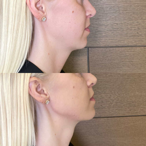How Long Does It Take For Swelling From Lip Filler To Go Down
