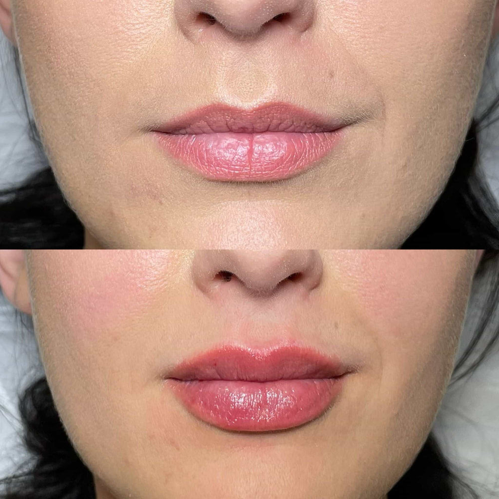 Do fillers cost more than Botox?