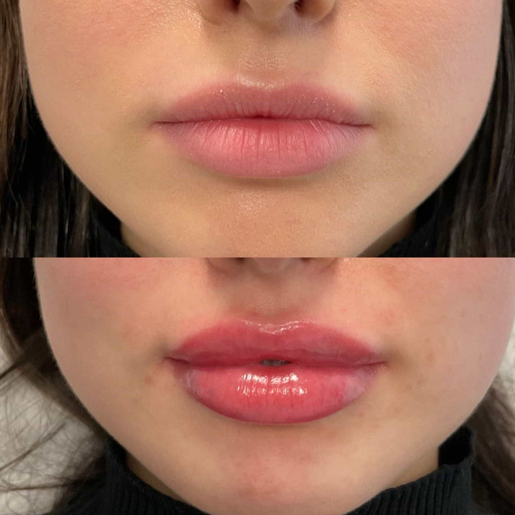 Can You Get Lip Injections While Pregnant or Breastfeeding?