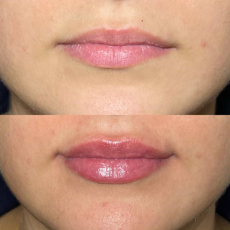 Can You Get Lip Injections While Pregnant or Breastfeeding?