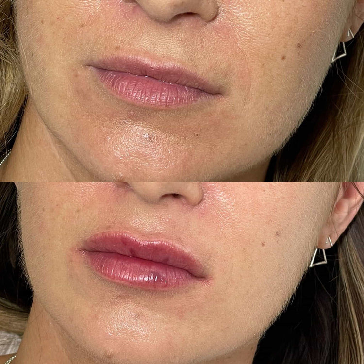 Is Filler Dissolving Treatment painful