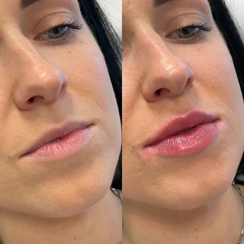 Does filler ever truly go away?
