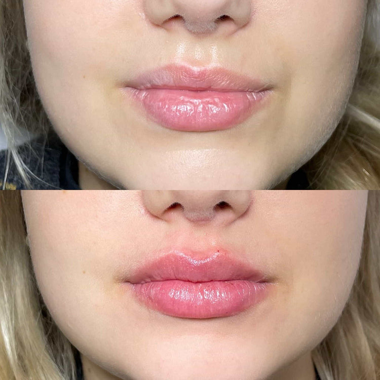 Tips for First-Time Lip Filler Patients in London