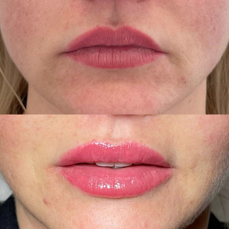 Are Lip Fillers Reversible? What UK Clients Need to Know