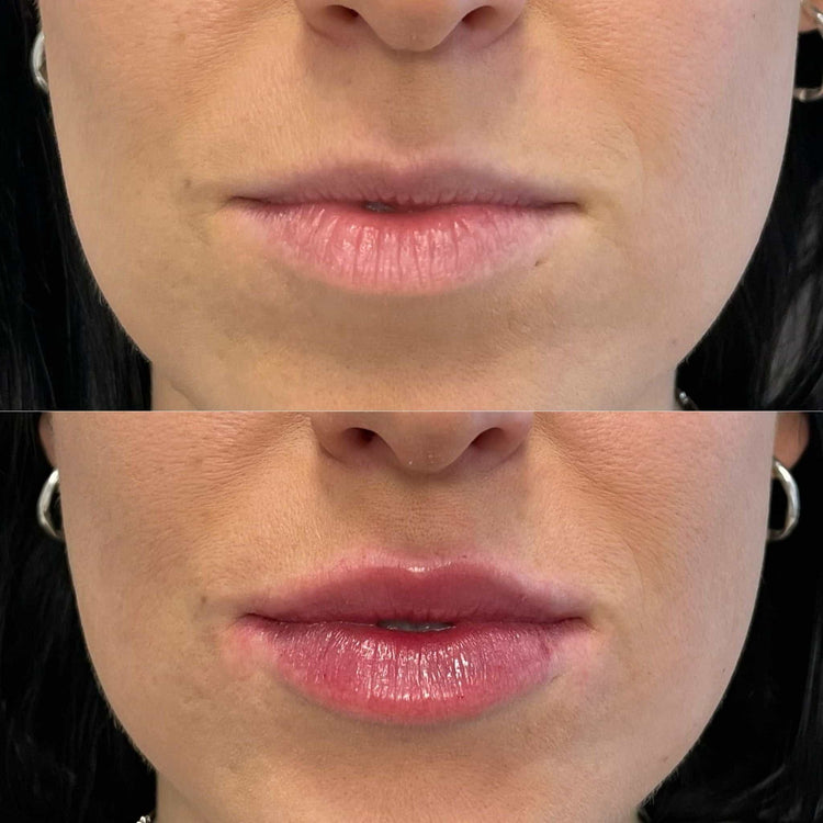 Tips for First-Time Lip Filler Patients in London