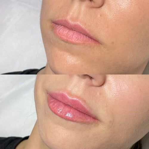 Is 60 too old for fillers?