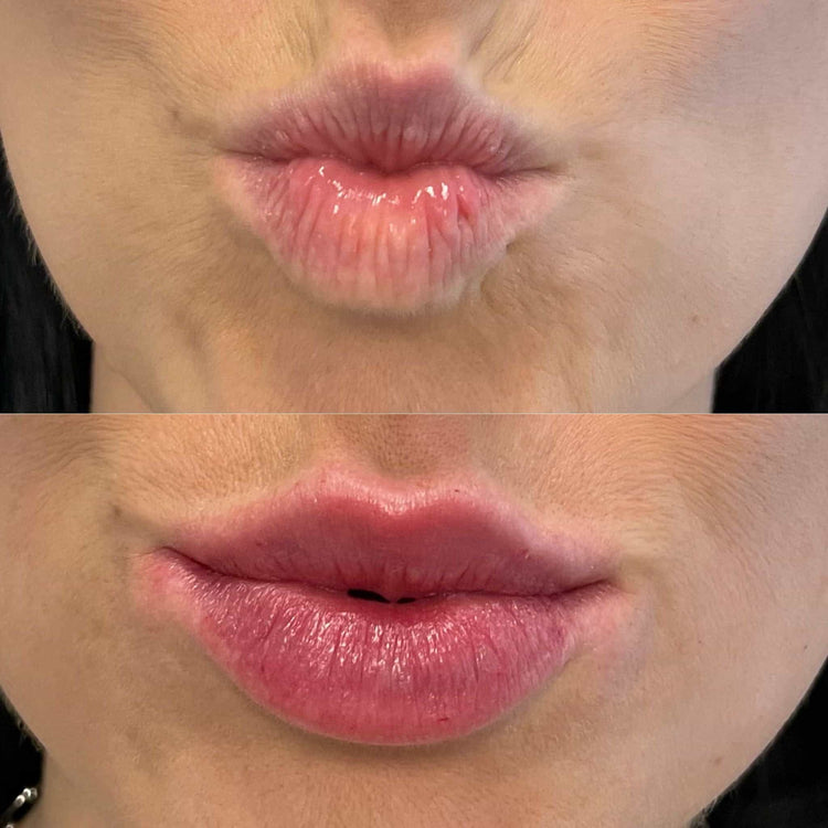 Tips for First-Time Lip Filler Patients in London