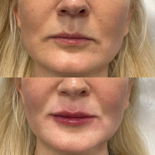 How Long After Lip Filler Can I Use Sunbed