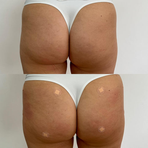 Non Surgical Butt Lift in Carshalton Surrey