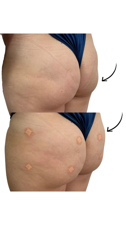 How to Identify and Avoid Bad Practices in Bum Filler Procedures