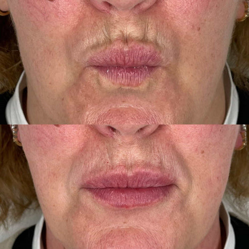 When Can You Take Ibuprofen After Lip Filler