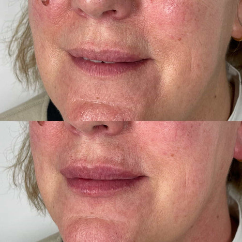 What Is The Russian Technique Lip Filler