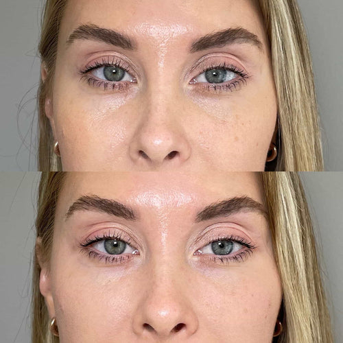 Can smile line fillers go wrong?